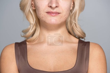 Foto de Vista recortada de mujer rubia con problemas de piel de pie aislado en gris - Imagen libre de derechos