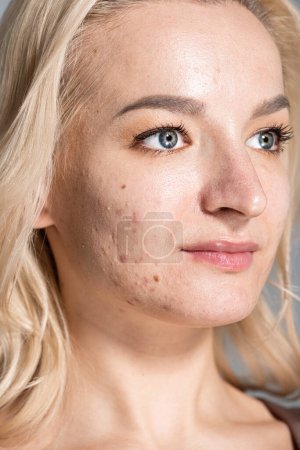 Téléchargez les photos : Portrait de femme avec la peau et l'acné de problème regardant loin isolé sur gris - en image libre de droit