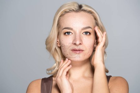 Retrato de modelo rubio con problema de piel tocando la cara aislada en gris 