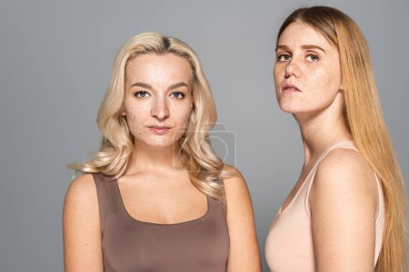 Foto de Modelos con problemas de piel mirando a la cámara mientras están aislados en gris - Imagen libre de derechos