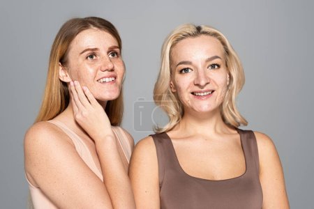 Overjoyed women with skin issues posing isolated on grey 