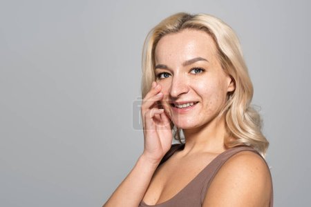 Smiling woman with acne on face touching cheek isolated on grey 