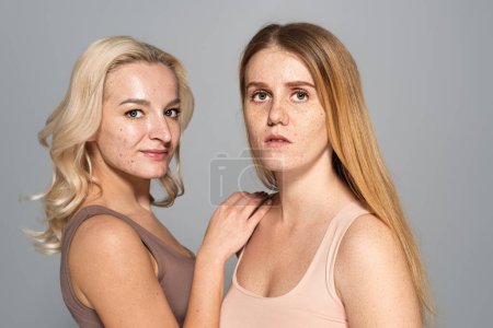 Photo for Smiling woman with acne on face standing near model with freckles isolated on grey - Royalty Free Image