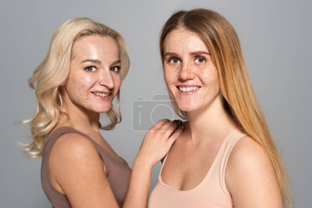Carefree women with skin issues looking at camera isolated on grey 