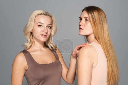 smiling model with problem skin standing near friend with freckles isolated on grey 