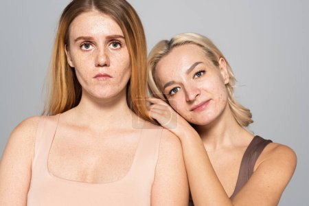 Blonde woman with acne on face standing near friend with freckles isolated on grey 