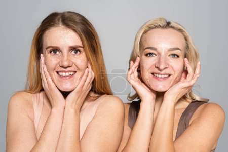 Positive friends with problem skin touching face isolated on grey 