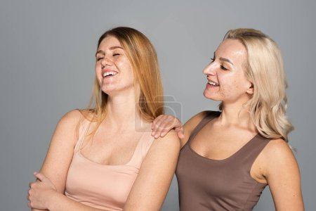 Positive blonde woman with acne standing near friend isolated on grey 