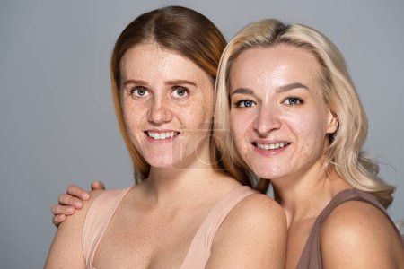 Photo for Portrait of blonde woman with problem skin hugging smiling friend with freckled face isolated on grey - Royalty Free Image