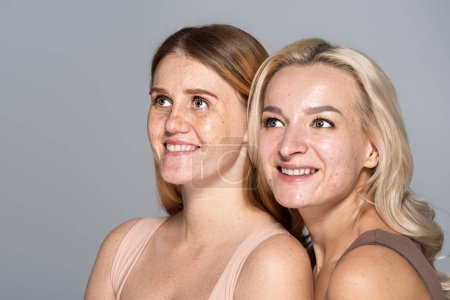 Foto de Modelos sonrientes con problemas de piel mirando hacia otro lado aislados en gris - Imagen libre de derechos