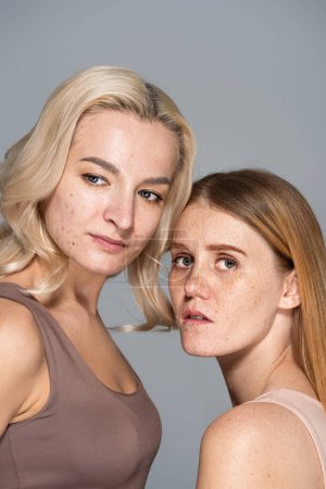 Portrait of freckled woman looking at camera near friend with acne isolated on grey 