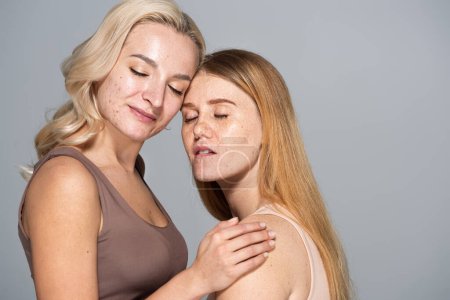 Foto de Modelos con problemas en la piel cerrando los ojos mientras posan juntos aislados en gris - Imagen libre de derechos