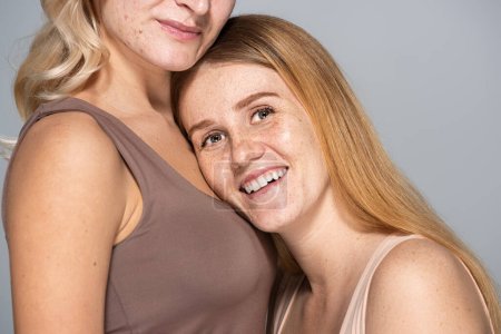 Positive freckled woman standing near friend with skin issue isolated on grey 