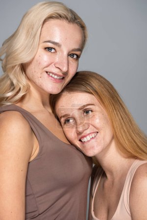 Cheerful young model with freckles standing near friend with acne isolated on grey 