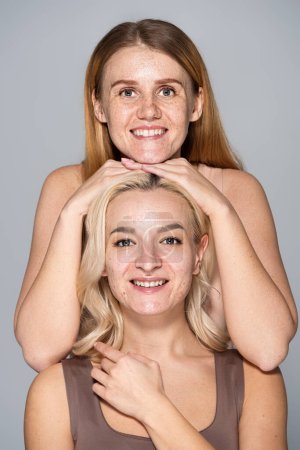 Positive freckled woman posing near friend with acne isolated on grey 