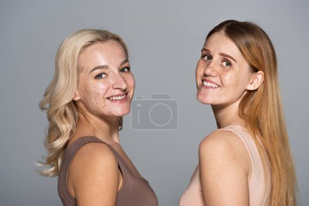Photo for Positive models with acne and freckles looking at camera isolated on grey - Royalty Free Image