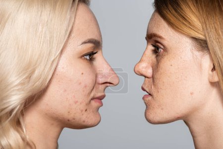 Photo for Profile of women with problem skin standing face to face isolated on grey - Royalty Free Image