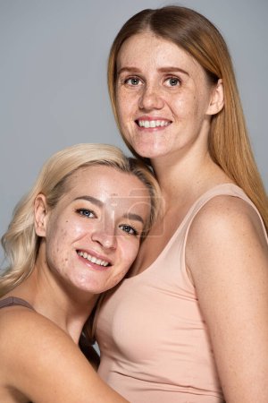 Foto de Mujeres alegres con problemas de piel mirando a la cámara aislada en gris - Imagen libre de derechos