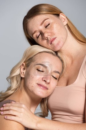 Mujer pecosa abrazando amigo con problemas de piel y ojos cerrados aislados en gris 