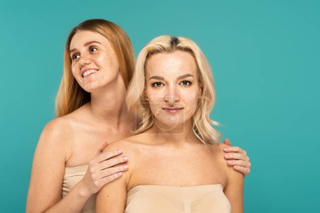 Téléchargez les photos : Femme insouciante avec des taches de rousseur étreignant ami avec l'acné isolé sur turquoise - en image libre de droit