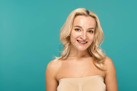 Portrait of smiling blonde woman with acne looking at camera isolated on turquoise