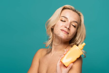 Téléchargez les photos : Femme heureuse et blonde avec de l'acné tenant bouteille avec de la crème solaire isolé sur turquoise - en image libre de droit