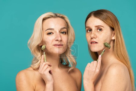 Téléchargez les photos : Femme avec acné et rousse modèle avec taches de rousseur levant les visages avec des rouleaux de jade isolé sur turquoise - en image libre de droit