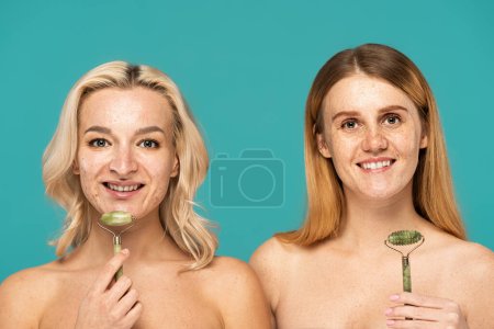 Photo for Cheerful woman with acne and redhead model with freckles holding jade rollers isolated on turquoise - Royalty Free Image