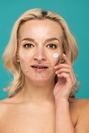 blonde woman with acne applying cream on face isolated on turquoise 