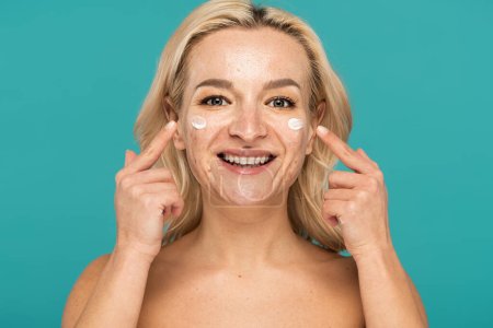 cheerful woman with acne applying cream and pointing with fingers at face isolated on turquoise 