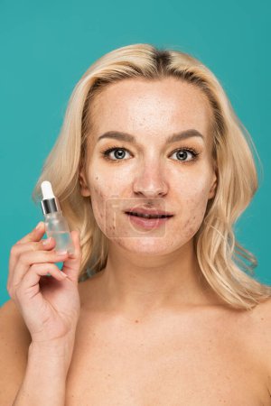 blonde woman with acne on face holding bottle with treatment serum isolated on turquoise