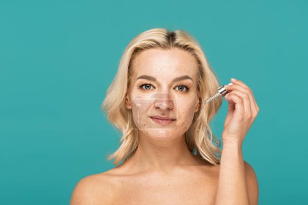 blonde woman with acne on face holding pipette with moisturizing serum isolated on turquoise