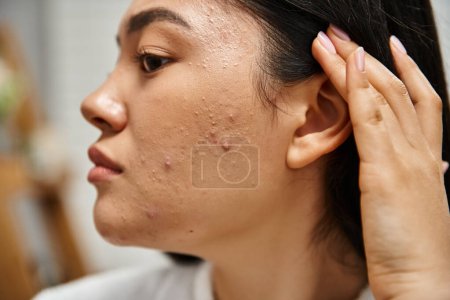 skin care issues concept, close up shot of young asian woman with brunette hair and acne on face puzzle 692759510
