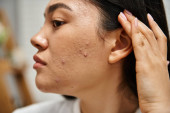 skin care issues concept, close up shot of young asian woman with brunette hair and acne on face Longsleeve T-shirt #692759510