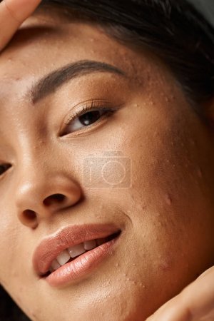 Nahaufnahme Foto von jungen asiatischen Frau mit Akne anfällige Haut Blick in die Kamera, Hautprobleme Konzept