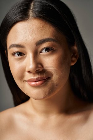 Foto de Complacido joven mujer asiática con problemas de piel y hombros desnudos mirando a la cámara sobre fondo gris - Imagen libre de derechos