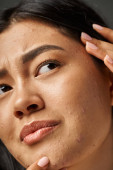 close up photo of concerned young asian woman with brunette hair touching her face with acne magic mug #692760548