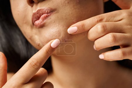 Photo for Close up photo of cropped young woman with acne prone skin popping pimple on face, skin issues - Royalty Free Image