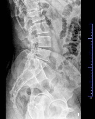 Foto de Radiografía de rayos X de la pelvis y la columna vertebral, vista lateral - Imagen libre de derechos