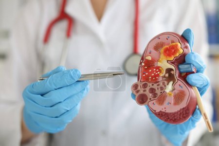 Téléchargez les photos : Doctor in hospital is standing holding anatomical model of kidney. Nephrology kidney transplant surgery and diseases concept - en image libre de droit
