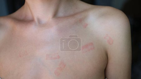 Foto de Red allergic spots rash on female body. Erythema causes symptoms of the disease - Imagen libre de derechos