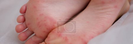 Foto de Sarpullido doloroso manchas rojas ampollas en la pierna del niño. Niños piel con dermatitis eccema y enfermedad viral - Imagen libre de derechos