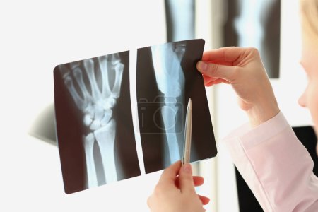 Téléchargez les photos : Femme médecin regarde la radiographie d'une blessure au bras à l'hôpital. Séquelles de blessures aux mains et d'arthrite - en image libre de droit