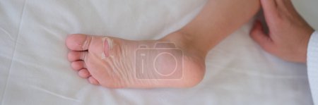 Photo for Child foot with flaky skin after burn or coxsackie virus closeup. Consequences on skin after rash from hand-foot-mouth syndrome concept - Royalty Free Image