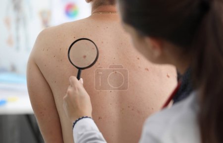 Doctor looks through magnifying glass mole patient. Doctor is highly qualified and skilled. Appeal to specialist. Effective treatment using drug methods. Skin scrutiny. Preservation youth and health