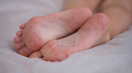 Foto de Eczema is an irritation caused by an allergic lesion of skin of feet in child. Infectious skin diseases in children - Imagen libre de derechos