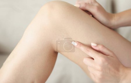 Foto de Cicatriz ligera en piel en pierna de mujer. Restauración de la piel en caso de cicatrices y heridas concepto - Imagen libre de derechos