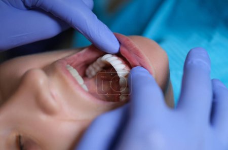 Téléchargez les photos : Médecin dentiste examinant la cavité buccale du patient avec des placages en gros plan. Installation du concept des placages composites et zirconium - en image libre de droit