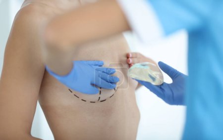 Téléchargez les photos : Le chirurgien plastique tient un implant thoracique en silicone pour une augmentation mammaire. Chirurgie plastique pour correction mammaire concept - en image libre de droit