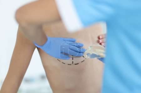 Téléchargez les photos : Médecin tenant l'implant devant le patient avec des marques préopératoires sur le gros plan du sein. Concept de mammoplastie - en image libre de droit
